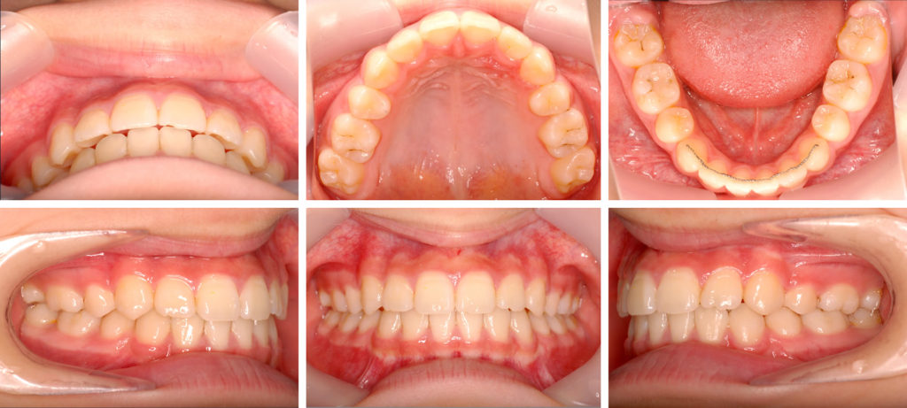 治療後の歯の写真